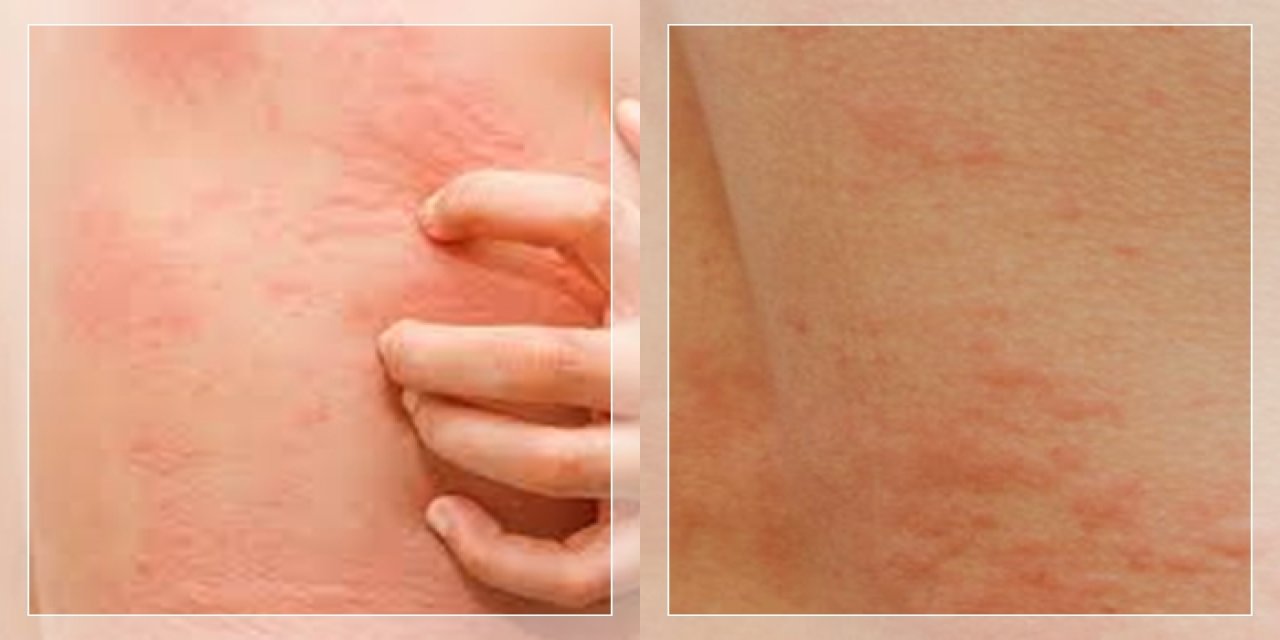 Urticaria Hives Symptoms And Treatment 4440